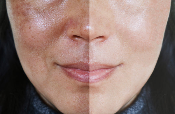 How Can You Reduce Enlarged Pores?