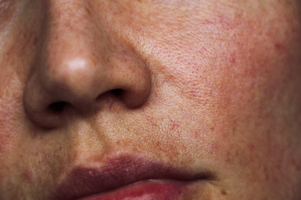 How to Tackle Hyperpigmentation Around the Mouth?