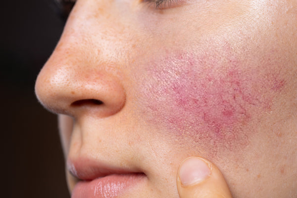 What Skincare Ingredients To Avoid If You Have Rosacea?