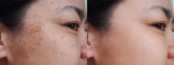 How to Get Rid of Dark Spots on Face?