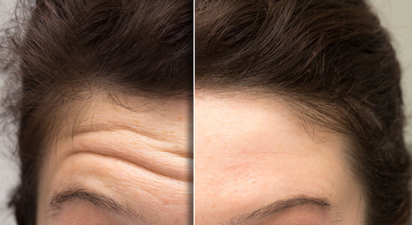 How to Reduce Wrinkles on Forehead?