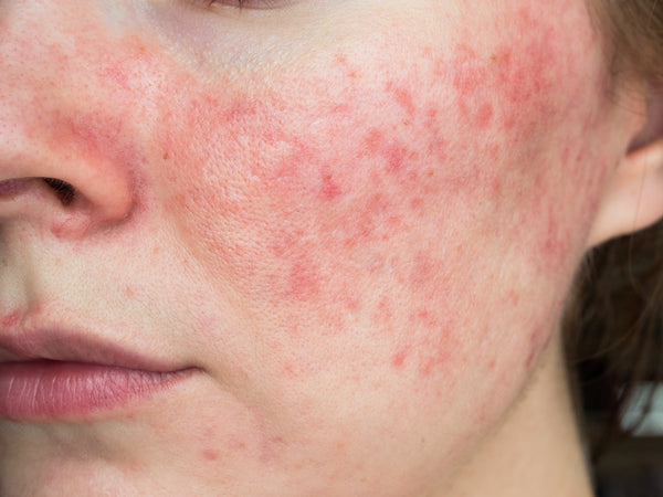 What Does Azelaic Acid Do for Rosacea?