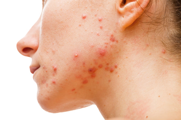 How to Get Rid of Pimples?