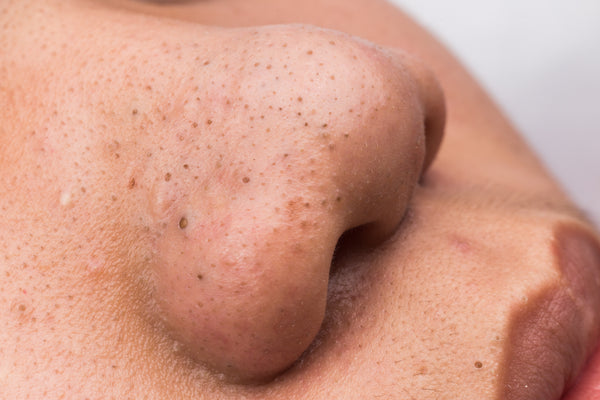 How to Remove Blackheads on Nose?