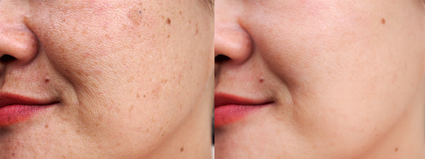 What Skin Care Tips Can Help You Manage Dark Spots