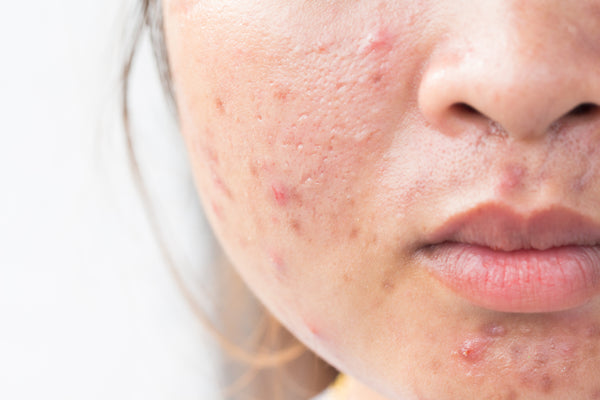 How to use Tamanu Oil for Acne