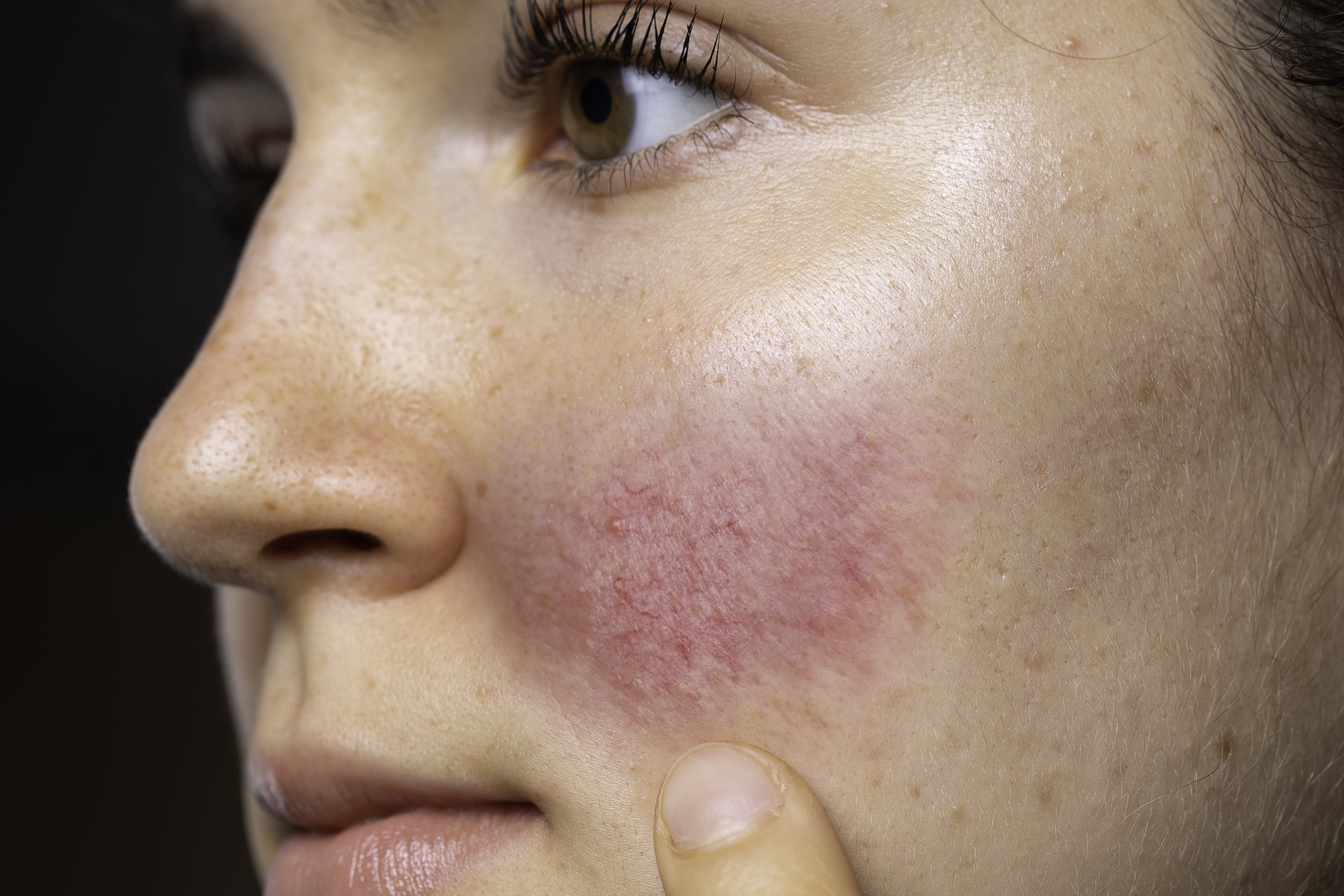 How to use Azelaic Acid for Rosacea? – Procoal