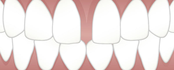 Diastema- The Mighty Tooth Gap Hype