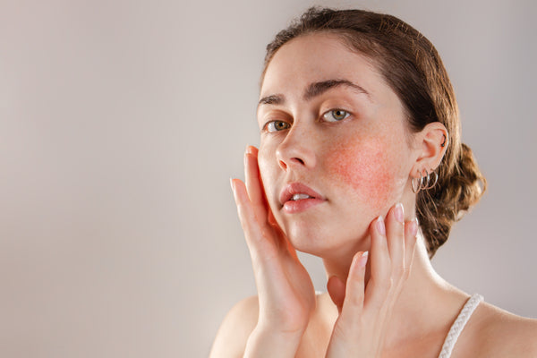 Can you Use Retinol with Rosacea?