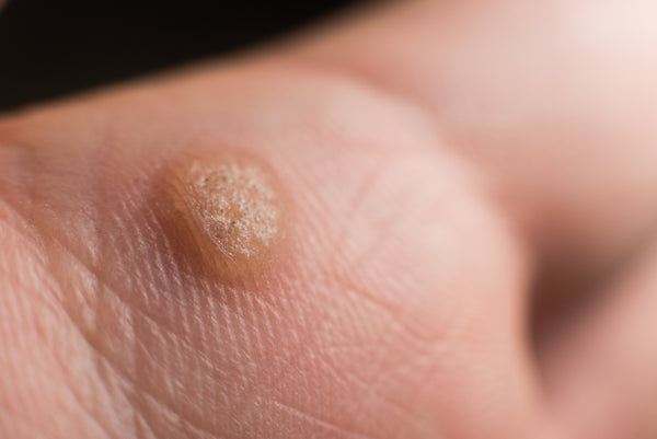 Can You Use Salicylic Acid to Remove Warts?